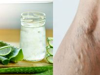 വെരിക്കോസ് വെയിന് കറ്റാര്‍ വാഴ പരിഹാരം