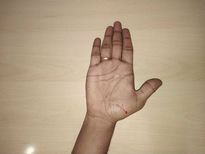 പുരുഷന്റെ കൈയ്യിലെ എക്‌സ്, വന്ധ്യതയുടെ ലക്ഷണം