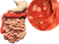 വയര്‍ വീര്‍ക്കുന്നത് ഗുരുതര രോഗലക്ഷണമാണ്