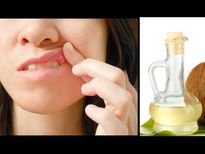 വായ്പ്പുണ്ണു മാറാന്‍ വെളിച്ചെണ്ണ പ്രയോഗം