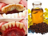 പല്ലിലെ ഏത് കറയും കളയാന്‍ അഞ്ച് മിനിട്ട്
