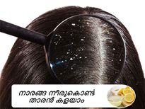 വെളുത്തുള്ളിയും നാരങ്ങ നീരും താരന്റെ പൊടിപോലുമില്ല