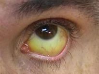 കണ്ണില്‍ ഈ നിറമാണോ,കരള്‍ പ്രശ്‌നത്തില്‍