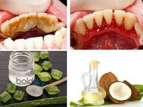 പല്ലിലടിഞ്ഞ് കൂടിയ ഈ വൃത്തികേട് ഇനിയില്ല