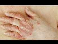 ചുണങ്ങു മാറാന്‍ നാടന്‍ പ്രതിവിധികള്‍