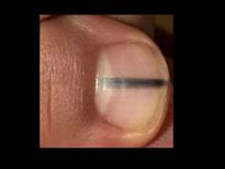 നഖത്തിലെ ഈ കറുത്ത വര ഗുരുതരസൂചന