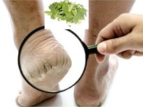 ഉപ്പുററി വിണ്ടു പൊട്ടുന്നതിന് വേപ്പിലയും മഞ്ഞളും