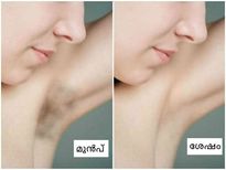 ഇരുണ്ട കക്ഷം വെളുപ്പിക്കാം, ബേക്കിംഗ് സോഡ ഇങ്ങനെ