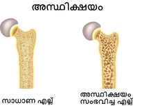  വനിതാദിനം; സ്ത്രീകളിലെ അസ്ഥിക്ഷയം ഗുരുതരം?