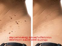 ആവണക്കെണ്ണ ബേക്കിംഗ്‌സോഡ; അരിമ്പാറ കൊഴിഞ്ഞ് പോവും