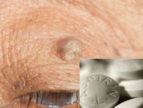 ഒറ്റ ഗുളികവിദ്യയില്‍ അരിമ്പാറ അപ്രത്യക്ഷം, വരില്ല