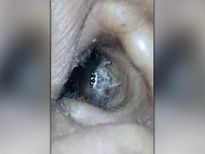 ചെവിക്കുള്ളിലുണ്ടായിരുന്നത് ജീവനുള്ള ചിലന്തി