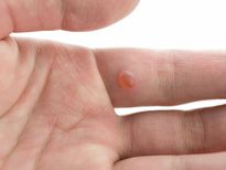  തൊലി പുറത്തുണ്ടാകുന്ന കുമിളകൾ ; കാരണങ്ങൾ 