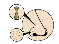 ബ്ലാക്ക്‌ഹെഡ്‌സ് കളയാന്‍ വെറും മൂന്ന് മിനിട്ട്