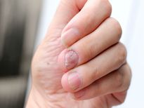 പ്രോട്ടീന്‍ കുറവെങ്കില്‍ കാണിക്കും അപകടലക്ഷണം