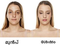 മുഖത്തെ കരുവാളിപ്പിന് സ്ഥിര പരിഹാരം