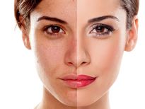 മുഖത്തെ ഇരുണ്ട കുത്തു മാറാന്‍ വഴിയിതാ