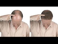 ആണിന്റെ മധ്യഭാഗത്തെ കഷണ്ടി ആ രോഗ സൂചന