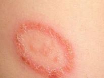 ചർമ്മം നോക്കിയാൽ അറിയാം പ്രമേഹം കൂടുതലോ എന്ന്