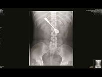 വിഴുങ്ങിയത് 5 ഇഞ്ചിന്റെ സ്പൂണ്‍ പക്ഷേ സംഭവിച്ചത്