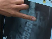 ഉറക്കത്തില്‍ എയര്‍പോഡ് വിഴുങ്ങി; കിട്ടിയതാണ് രസം