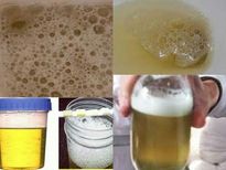 മൂത്രത്തില്‍ പത വൃക്ക രോഗത്തിന്‍ ആദ്യ സൂചന