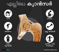  എല്ലിലെ ക്യാന്‍സര്‍; നീരും വേദനയും സ്ഥിരം ലക്ഷണം
