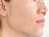 ഈ കറുത്ത കുത്തുകള്‍ക്ക് മികച്ച ഒറ്റമൂലി പെട്ടെന്ന്