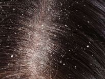 താരനെ മുഴുവൻ മാറ്റും നേന്ത്രപ്പഴം ഒലീവ്ഓയിൽ മിക്സ്