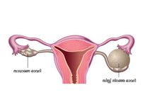 ഗർഭധാരണത്തിന് തടസ്സം നിൽക്കും പ്രധാന കാരണം ഇതാവാം