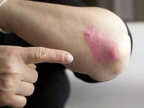 ചർമ്മത്തിൽ ചെറിയമാറ്റങ്ങൾ അപകടമാണ് അതിലേറെ ഗുരുതരം