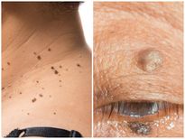 അരിമ്പാറ, ബ്രൗണ്‍കുത്തുകള്‍; വഴുതനങ്ങയില്‍ ഈസി വഴി