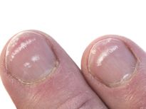 നഖത്തിൽ വെളുത്ത കുത്തുകളോ, അപകടം തൊട്ടുപുറകേയുണ്ട്