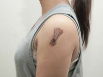 5വയസ്സിലെ ചിക്കന്‍പോക്സ് 32-ൽ സ്കിൻക്യാൻസറായി മാറി