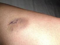 ശരീരത്തിലെ ഈ പാടുകൾ ഭയക്കേണ്ടതാണ്; ശ്രദ്ധിക്കണം