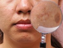 ഗർഭകാലത്ത് ചർമ്മത്തിൽ കരുവാളിപ്പോ, പ്രധാന കാരണമിതാ