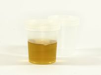 മൂത്രത്തിലെ പത നിസ്സാരമാക്കണ്ട, ശ്രദ്ധിക്കണം