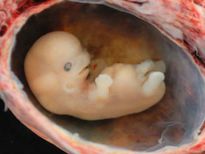  അബോര്‍ഷന്‍ പിന്നിലുണ്ട് അറിയാത്ത ചിലത്‌