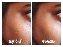 കവിളിലെ കറുത്ത പുള്ളികള്‍ 15ദിവസം കൊണ്ട് മായ്ക്കാം