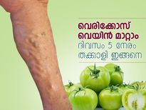 വെരിക്കോസ് വെയിന്‍ മാറ്റാം; 5 നേരം തക്കാളി ഇങ്ങനെ