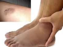 ഹൃദയത്തിന് തകരാറെങ്കില്‍ കൈയ്യും കാലും ഇങ്ങനെ