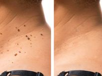 മാറാതെ നില്‍ക്കുന്ന അരിമ്പാറക്ക്  നാടന്‍ ഒറ്റമൂലി