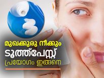 മുഖക്കുരു നീക്കും ടൂത്ത്‌പേസ്റ്റ് പ്രയോഗം ഇങ്ങനെ