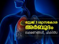 സഞ്ജയ് ദത്തിനെ ബാധിച്ച സ്റ്റേജ് 3 ശ്വാസകോശാര്‍ബുദം