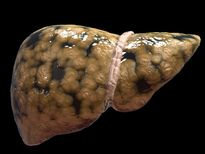  ഫാറ്റി ലിവര്‍ അത്യന്തം അപകടം; ഡയറ്റ് ശ്രദ്ധിക്കാം