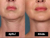 കഴുത്തിലെ ചുളിവകറ്റാം; ഞൊടിയിടയില്‍ പരിഹാരം