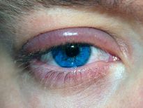 കണ്ണില് എന്തെങ്കിലും തടയുന്നുവോ, പരിഹാരം ഇതാ