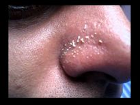 വൈറ്റ്‌ഹെഡ്‌സില്ല പ്രായം കുറക്കും ഒറ്റമൂലി