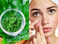 മുഖക്കുരു എളുപ്പം മാറും വേപ്പിലയും ഈ കൂട്ടും