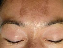 ഗര്‍ഭകാലത്ത് മുഖത്തെ ഈ പാടിന് കാരണവും പരിഹാരവും കൈക്കുള്ളില്‍